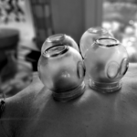 TuinAlp Médecine traditionnelle Chinoise massages TuiNa traitement par les ventouses